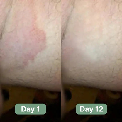 Noravo Antifungal Soap